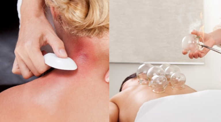 Cupping & Gua Sha